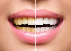 zestawienie przebarwionych zębów i wybielonych