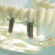 implant-zebowy