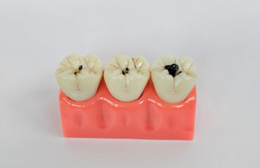 czy-prochnica-jest-choroba-zakazna