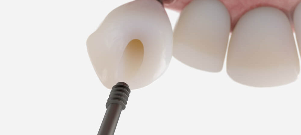 przeszczep-kosci-przed-wszczepieniem-implantu