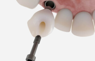 przeszczep-kosci-przed-wszczepieniem-implantu