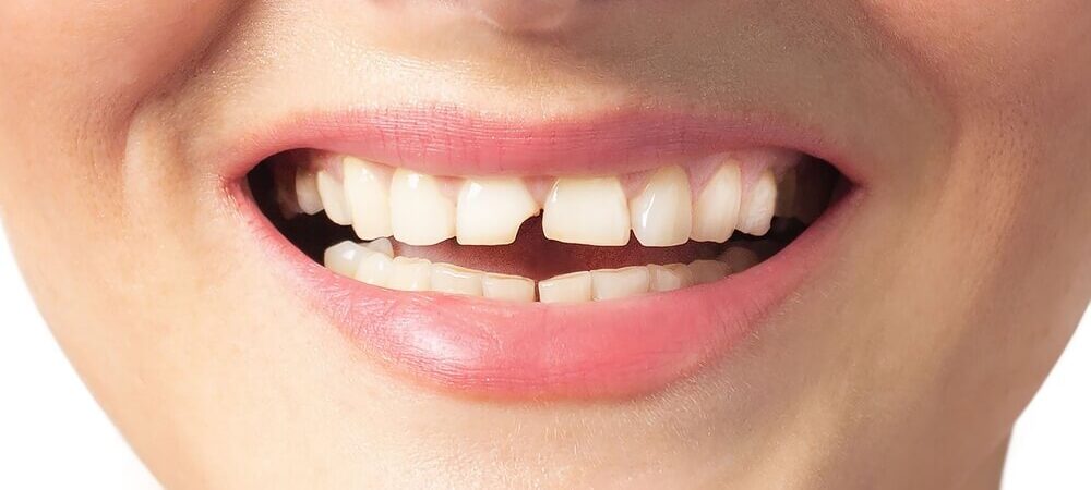 odbudowa-zlamanego-zeba