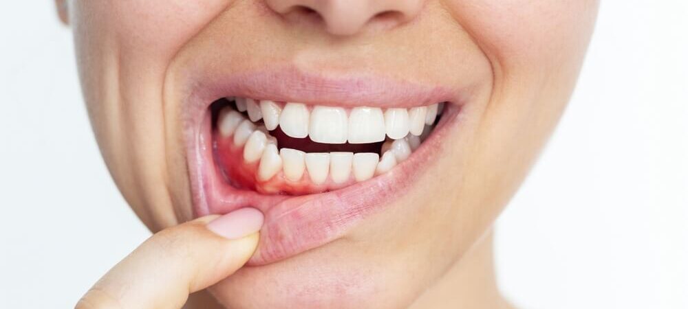 jakie-sa-skutki-nieleczonych-stanow-zapalnych-dziasel