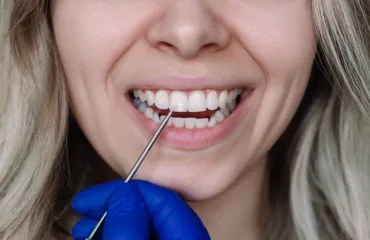 Dentysta wskazuje białą plamę na przednim zębie pacjentki podczas badania stomatologicznego.